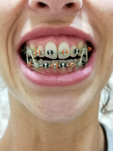 Halloween Braces, Braces Rubber Bands, Orthodontic Appliances, Cute Braces, Ear Ring, Rubber Bands, Braces, Band, Halloween