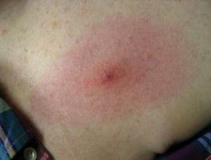 Bulls Eye Rash (Erythema Migrans) Tick Bite Rash, Severe Fatigue, Deer Ticks, Tick Bite, The Tick, Severe Headache, Disease Symptoms, Body Fluid, Research Centre