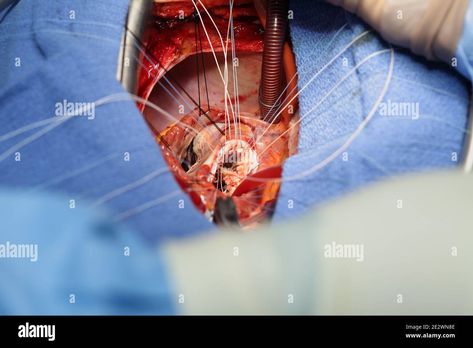 Download this stock image: Process of open heart surgery. - 2E2WN8E from Alamy's library of millions of high resolution stock photos, illustrations and vectors. Cheer Picture Poses, Open Heart Surgery, Heart Surgery, Cheer Pictures, Fairytale Dress, Image Processing, Open Heart, Picture Poses, Biology