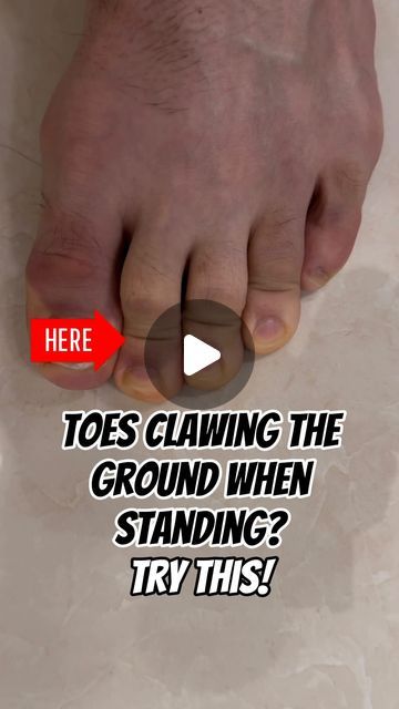 Pain Free Health on Instagram: "Are your toes clawing the ground when standing? It could be a sign of hammer toes, possibly linked to a muscle imbalance in the feet. Let’s unravel this together for healthier, happier steps! 👣 #FootHealth #MuscleBalance #hammertoe #hammertoes #footstrength #footstrengthening #feetstrengthening #physio #physiotherapy #physicaltherapy" Hammertoe Remedies, Hammer Toe Correction, Essex Boys, Toe Exercises, Summer Body Workout Plan, Therapy Exercises, Foot Exercises, Sciatica Exercises, Physical Therapy Exercises