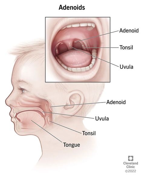 Tonsils And Adenoids, Soft Palate, Tissue Types, Nasal Passages, Healthy Juice Recipes, Natural Cold Remedies, Turmeric Benefits, Pelvic Pain, Bacterial Infection