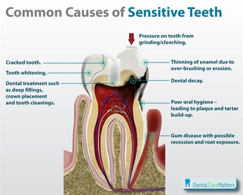 If you wince with pain after sipping a hot cup of coffee or chewing a piece of ice, chances are that you suffer from "dentin hypersensitivity," or more commonly, sensitive teeth. Hot and cold temperature changes cause your teeth to expand and contract. Over time, your teeth can develop microscopic cracks that allow these sensations to seep through to the nerves. Exposed areas of the tooth can cause pain and even affect or change your eating, drinking and breathing habits. Sensitive Teeth Remedy, Dental Decay, Dental Facts, American Dental Association, Tooth Enamel, Tooth Pain, Tooth Sensitivity, Dental Crowns, Periodontal Disease