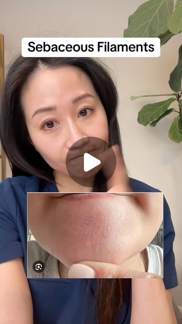 Jenny Liu, MD FAAD , Skincare Derm on Instagram: "Skincare combos to tackle some common concerns 

1️⃣ Sebaceous filaments: Adapalene + moisturizer like @larocheposayusa Toleriane to promote skin turnover and maintain a healthy barrier.
2️⃣ Hair loss: Adapalene + minoxidil 5%, because retinoids help enhance minoxidil’s effectiveness.
3️⃣ Dark neck (Acanthosis Nigricans): Adapalene + urea 20% from @cetaphil Rough and Bumpy cream to smooth texture, reduce skin thickening, and tackle hyperpigmentation.

Adapalene isn’t just for acne may be helpful for others concerns too. 

Have you tried any of these combinations?
#sebaceousfilaments #androgenicalopecia #darkneck #skincarehacks #derm #skincaretips" Skincare Combos, Dark Neck, Acanthosis Nigricans, Sebaceous Filaments, Androgenic Alopecia, Instagram Skincare, Bumpy Skin, Natural Body Care, Effective Skin Care Products