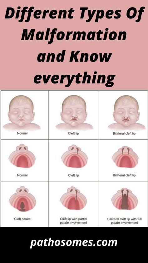 Different Types of malformation Praxis Study, Cleft Lip And Palate, Cleft Palate, Cleft Lip, Mother Baby Nurse, Spina Bifida, Baby Nurse, Congenital Heart Defect, Heart Defect