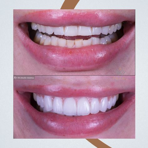 Before and After - Hollywood smile makeover !!!

#pearldentalclinic #Invislign #Braces #Smile #StaySafe #aligners #TopDentalClinic #InternationallyCertified #happysmiles #affordable #dubai #smile #lifestyle #dentist #friendlydentist #pearldentalclinic #teethwhitening #businessbay #dentalveneers #cosmeticdentist #citadeltower #veneers #beforeandafter Front Teeth Veneers Before And After, Small Teeth Smile, Veneers Before And After, Loose Teeth, Composite Bonding, 2014 Aesthetic, Composite Veneers, Chipped Tooth, Hollywood Smile