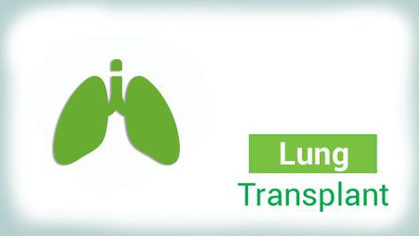 Lung transplant is a complex surgery, and adequate nutrition plays a vital role in the healing process | Foods to Avoid After Lung Transplant. Doctor Help, Lung Transplant, Healthy Lungs, The Healing Process, Help Digestion, Feeling Hungry, Foods To Avoid, Proper Nutrition, Healthy Diet Plans