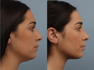 Weak Chin Profile, Chin Implant Before And After, Weak Chin, Exercise Face, Chin Reduction, Double Chin Reduction, Double Chin Removal, Chin Exercises, Face Fat