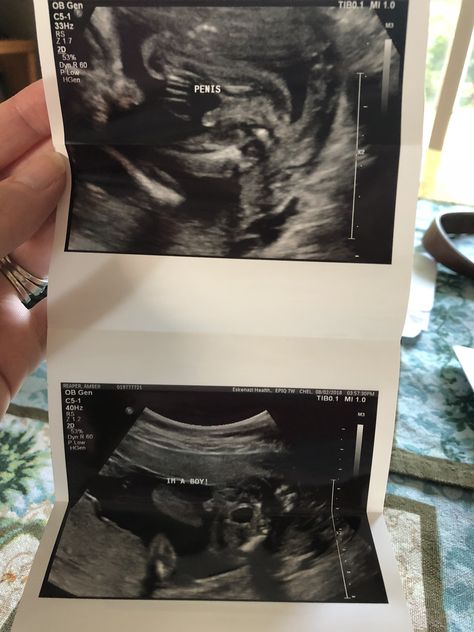 Ultrasound photos of our baby boy. Hunter James Stanfield, due to arrive on Christmas Day 2018. Boy Ultrasound Pictures, Boy Ultrasound, Baby Ultrasound, Ultrasound Pictures, Our Baby, Ultrasound, Christmas Day, A Boy, Gender Reveal