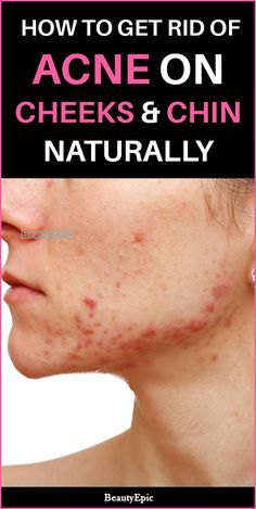 Acne On Cheeks, Chin Acne Causes, Cheek Acne, Chin Acne, Warts On Face, Chest Acne, Face Mapping Acne, Forehead Acne, Get Rid Of Acne