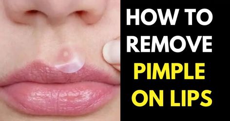 remove pimple on lips Pimples On Lip Line, Cystic Acne On Chin, Lip Pimple, Peroxide For Acne, Painful Pimple, Home Remedies For Pimples, Blackheads On Nose, Pimples Remedies, How To Get Rid Of Pimples