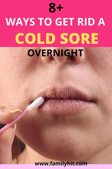 Cold Sore Remedy Fast, Cold Sore Remedy Overnight, Get Rid Of Cold, Fever Blister, Cold Sores, Canker Sore, Cold Sores Remedies, Spots On Face, Cold Sore