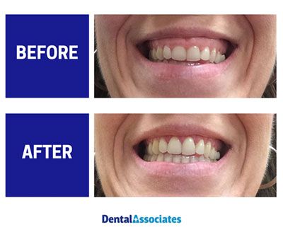 Crown Lengthening: How I Fixed My Small Teeth with Simple Procedure Crown Lengthening Before And After, Small Teeth Smile, Teeth Transformation, Crown Lengthening, Teeth Makeover, Fix Teeth, Dental Aesthetics, Veneers Teeth, Loose Tooth