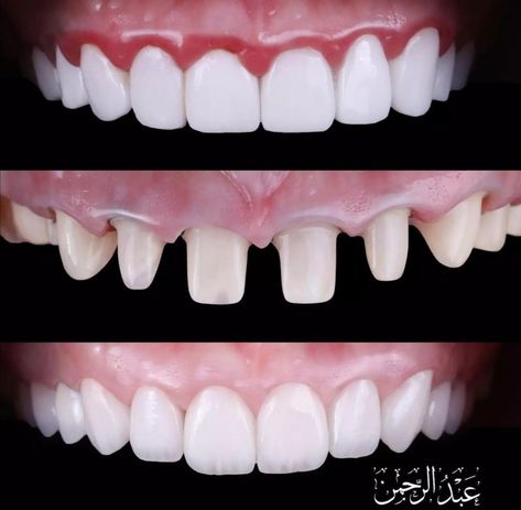 Dental Crowns Before And After, Dental Morphology, Operative Dentistry, Dentist Career, Teeth Veneers, Dental Animation, Medical Items, Teeth Whitening Methods, Tooth Crown