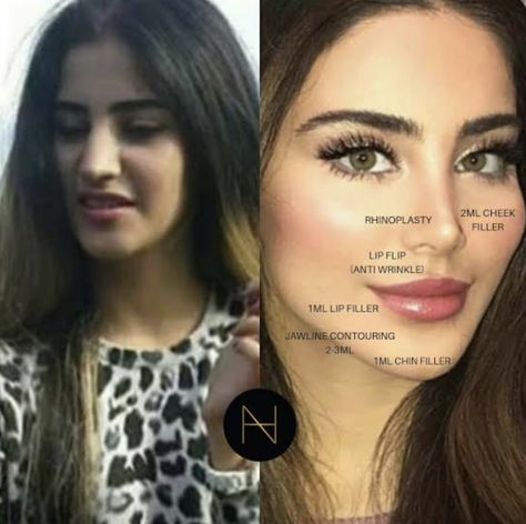 Lip Job, Face Plastic Surgery, Rhinoplasty Nose Jobs, Face Fillers, Beauty Recipes Hair, Pretty Nose, Perfect Nose, Facial Fillers, Facial Contouring