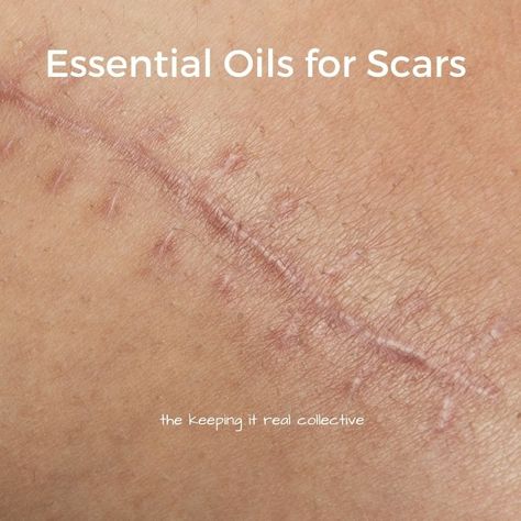 Essential Oils For Keloids, Scar Fading Remedies, Surgical Scar Remedies, Essential Oils For Healing After Surgery, Essential Oils For Scar Tissue, Natural Scar Remedies, How To Heal Scars Quickly, Essential Oils For Scars After Surgery, Essential Oils For Wound Healing