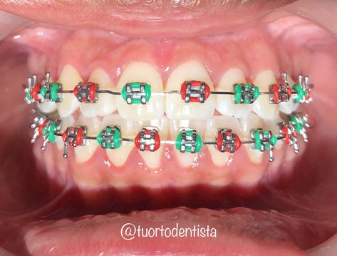 Braces Colors Christmas, Braces Colors For Christmas, Christmas Braces Color Ideas, Christmas Braces Colors, Christmas Braces, Brackets Ideas, Braces Colours, Braces Colors Combinations, Braces Ideas