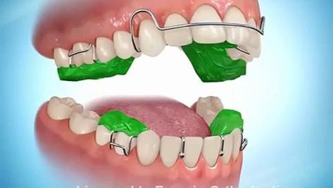 Orthodontics Teeth, Retainer Teeth, Dental Wallpaper, Teeth Aesthetic, New Year Wishes Images, Orthodontic Appliances, Dental Photography, Diamond Teeth, Brace Face