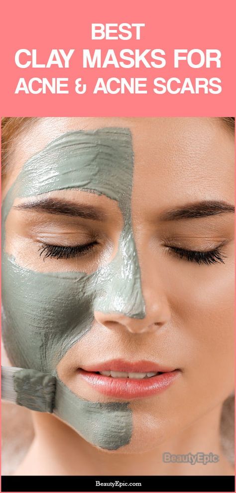 Best Clay Masks for Acne and acne Scars – Our Top 10 Best Clay Mask For Acne, Clay Mask For Acne, Scar Mask, Potato Face Mask, Face Masks For Acne, Best Clay Mask, Bio Oil Scars, Masks For Acne, Clear Up Acne