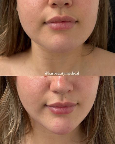 How amazing are these results?! This client came in with concerns about the shape of her face @aesthetic.nurse.rebecca used 1.5 ml of filler in her chin and the results speak for themselves 💉 Chin Filler, Aesthetic Nurse, Face Aesthetic, Glow Up Tips, The Shape, Glow Up?, Surgery, Asian Beauty, Medical