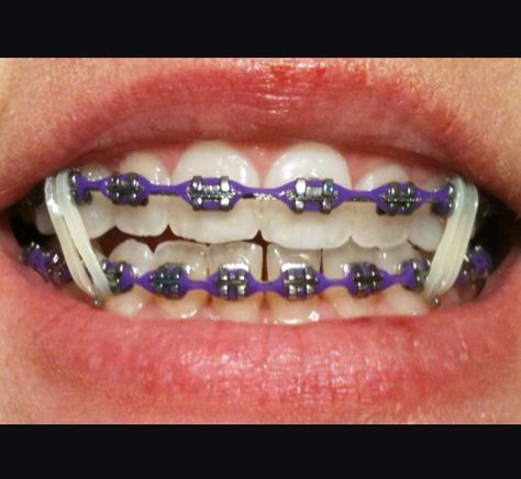 Purple Braces Power Chain Smile With Braces, Purple Braces, Power Chain Braces, Dental Braces Colors, Braces Colors Combinations, Invisible Teeth Braces, Braces Rubber Bands, Power Chain, Braces Bands