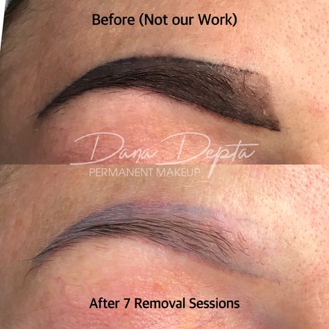 Bad Microblading, Permanent Makeup Removal, Pmu Brows, Semi Permanent Makeup, Makeup Removal, Eyebrow Tattoo, Tattoo Removal, Permanent Makeup, Semi Permanent