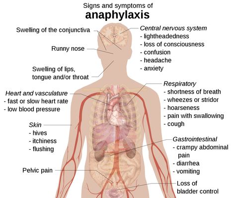 1467px-Signs_and_symptoms_of_anaphylaxis.svg How To Retain Information, Slow Heart Rate, Medical Things, Nursing School Essential, Anaphylactic Shock, Gallery Poster, Medicine Notes, Allergy Awareness, Bladder Control