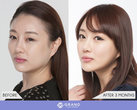 Square-jaw reduction Square Jaw Reduction, Square Jaw, Plastic Surgery Korea, Facial Images, Face Contour, Beauty Posters, Face Contouring, Body Mods, Korean Hairstyle