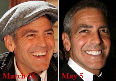 #GeorgeClooney #CosmeticDentistry #BeforeandAfter http://www.baselinedental.com Braces Humor, Celebrity Teeth, Celebrity Smiles, Dental Technician, Fake Teeth, Perfect Teeth, Celebrities Then And Now, Dental Veneers, Smile Makeover