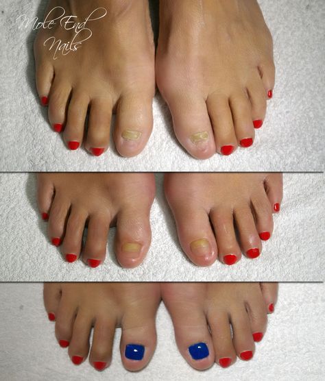 Toenail Reconstruction before and after #toenail #beforeafter Nail Tattoos, Summer Toes, Acrylic Toe Nails, Acrylic Toes, Nail Tattoo, Short Hair With Layers, Mole, Swag Nails, Toe Nails