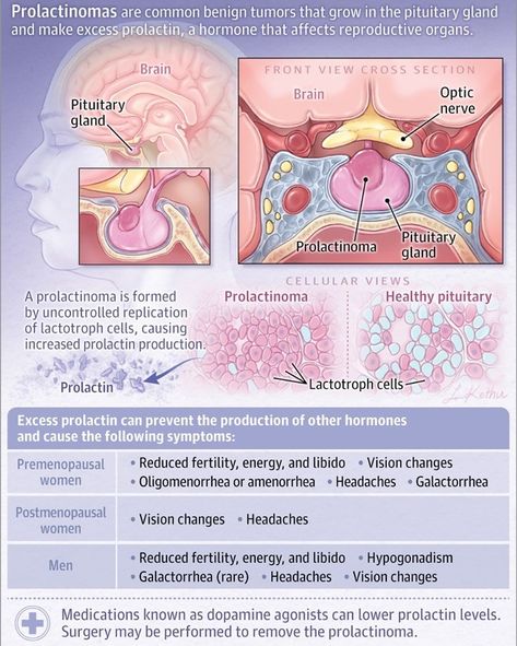 JAMA Network on Instagram: “Prolactinomas Prolactinomas are a benign pituitary gland tumor that produces excess prolactin, a hormone. In premenopausal women,…” Pituitary Adenoma, Illustration Layout Design, Pituitary Gland Tumor, Pituitary Tumor, Medical Learning, Diseases Pictures, Np School, Mcat Study, Nursing School Essential