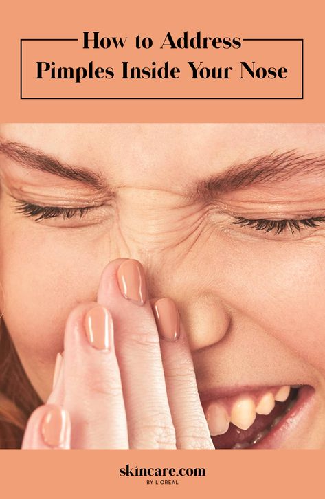 How to Get Rid of Pimples Inside Nose Sores Inside Nose, Pimple Inside Nose, Nose Pimples, Back Acne Remedies, Blind Pimple, Pimples Under The Skin, Trigun Stampede, Pimples Remedies, Prevent Pimples