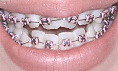 pink braces Light Pink Braces Teeth, Baby Pink Braces, Light Pink Braces, Pink Braces, Dental Braces Colors, Braces Elastics, Cute Braces Colors, Getting Braces, Braces Tips