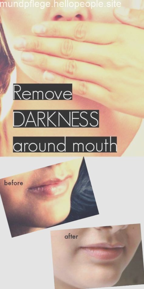 Magical home remedy to get rid of dark patches around mouth, #Dark #Home #Magical #mouth #patches #Remedy #Rid #zahnheilkunde Check more at http://mundpflege.hellopeople.site/magical-home-remedy-to-get-rid-of-dark-patches-around-mouth/ Darkness Around Mouth Home Remedies, Darkness Around Mouth, Dark Patches On Skin, Skin Lightening Diy, Natural Facial Mask, Korean Skin Care Secrets, Aloe Vera Skin Care, Hair Removal Remedies, Skin Face Mask