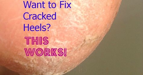 cracked heals, healing cracked heals, Listerine, microplane, foot soak, natural foot soak, DIY foot soak