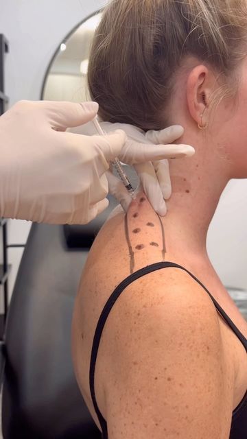 Trapezius Botox Before And After, Shoulder Botox Before And After, Botox In Shoulder, Trap Botox Before And After, Swan Neck, Botox Trapezius, Neck Botox Before And After, Botox Injection, Botox Aesthetic