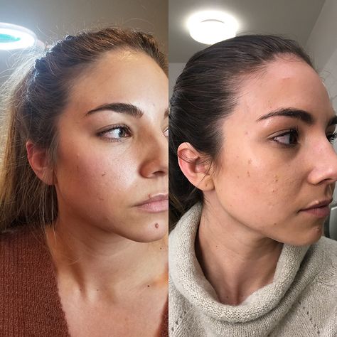 My Experience Receiving Botox for TMJ | Lauryncakes Botox Jaw, Jaw Pain Relief, Tmj Relief, Excessive Underarm Sweating, Botox Before And After, Botox Lips, Jaw Pain, Nose Surgery, Botox Fillers