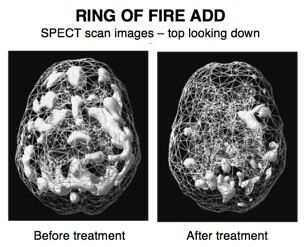 A Very Busy Brain – Week 6 of 7: Ring of Fire ADD - Amen Clinics Brain Scan, Health Psychology, Very Busy, Radiology, Brain Health, Neuroscience, Psychology Facts, Brain, Health And Nutrition