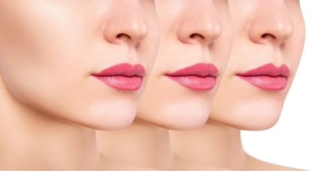 14 Lip Filler Shapes: How To Choose The Right Type Different Lip Filler Shapes, Lip Filler Shapes, Lip Filler Shape Ideas, Aesthetic Training, Shape Chart, Lip Filler, Cool Sculpting, Excessive Sweating, Lip Shapes