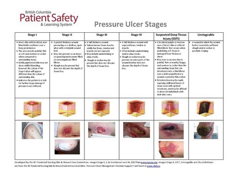 Pressure Ulcer Staging Guide Bowel Movement Chart, Pressure Ulcer Staging, Wound Care Nursing, Nurse Brain Sheet, Nursing School Inspiration, Pressure Ulcer, Medical School Life, Nurse Study Notes, Subcutaneous Tissue