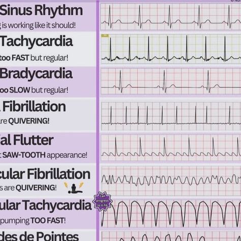 Surajit Tripura on Instagram: "Heart Rhythm | Health Sector" Heart Rhythm Nursing Cheat Sheets, Irregular Heart Rhythms, Ekg Rhythms, Nursing Cheat Sheet, Nurse Study, Nursing Cheat, Heart Rhythm, Nurse Study Notes, Normal Heart