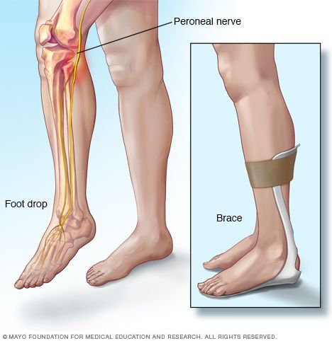 Multiple Sclerosis Exercise, Foot Drop Exercises, Leg Health, Ankle Strengthening Exercises, Cauda Equina, Orthotics And Prosthetics, Foot Stretches, Hip Injuries, Yoga Facts