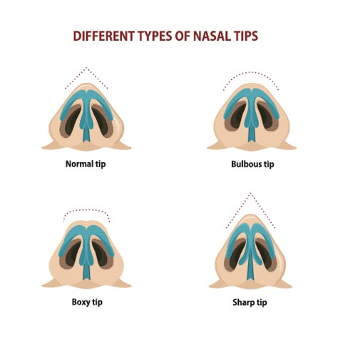 What is Bulbous Nose Job? Bulbous Nose Exercise, Bulbous Nose Aesthetic, Nose Job Bulbous Tip, Bulbous Tip Rhinoplasty, Wide Nose Rhinoplasty, Ethnic Nose Job, Bulbous Nose Rhinoplasty, Tip Rhinoplasty, Nose Job Recovery