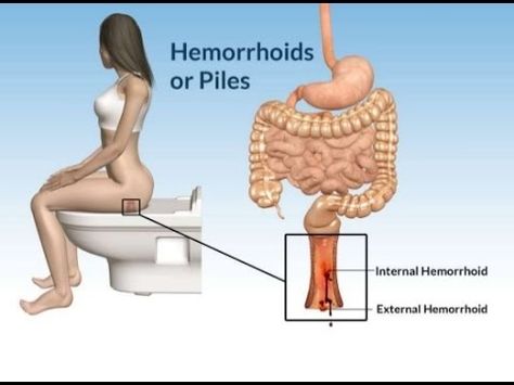 Hemorrhoid Removal, Alternative Treatments, Digestion Problems, Natural Home Remedies, Health Conditions, Natural Treatments, Health Problems, Home Remedies, Natural Remedies