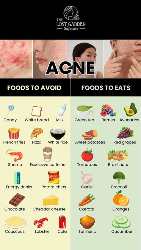 Want to fight acne through your diet? Find out the foods you should avoid and the ones you should include for healthier, acne-free skin. Visit our online shop for acne-fighting products and achieve clear skin! Food For Acne, Foods For Clear Skin, Clear Skin Diet, Acne Diet, Skin Diet, Acne Free Skin, Clear Healthy Skin, Makanan Diet, Clear Skin Tips