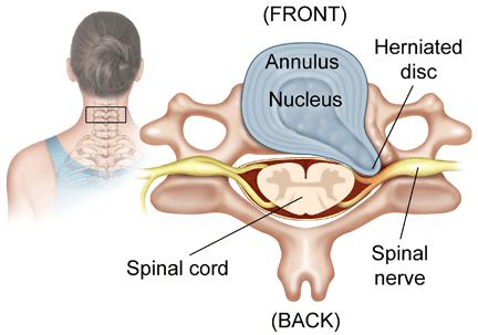 Cervical Disc, Intervertebral Disc, Disk Herniation, Bulging Disc, Spinal Surgery, Hip Problems, Spinal Nerve, Shoulder Pain Relief, Upper Back Pain