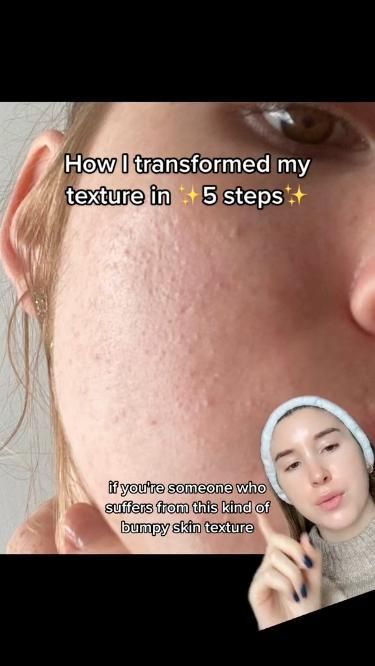 Discover effective techniques to remove skin texture and achieve a flawless complexion. Say goodbye to uneven skin and hello to smooth, radiant beauty. Textured Skin, Serious Skin Care, Bumpy Skin, Clear Skin Tips, Perfect Skin Care Routine, Healthy Skin Tips, Facial Skin Care Routine, Skin Routine, Skin Care Solutions