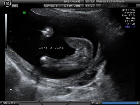 2d ultrasound its a girl Girl Ultrasound, Ultrasound Sonography, Ultrasound Pictures, Its A Girl, 16 Weeks, Normal Girl, Ultrasound, Gender Reveal, A Girl