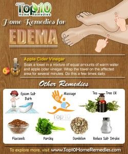 Home Remedies for Edema Water Retention Remedies, Top 10 Home Remedies, Reduce Swelling, Holistic Remedies, Natural Health Tips, Natural Therapy, Coriander Seeds, Natural Health Remedies, Natural Home Remedies