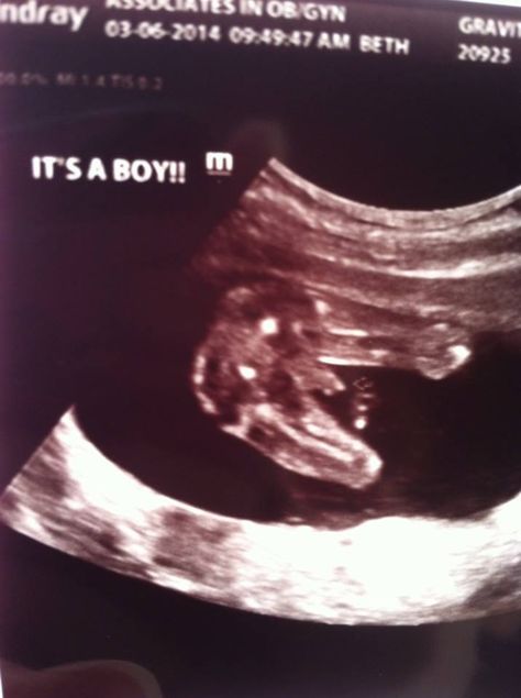 Gender reveal. Ultrasound. It's a boy! 19 weeks pregnant. 19 Week Ultrasound, 20 Week Ultrasound, Gender Reveal Ultrasound, 19 Weeks Pregnant, 4d Ultrasound, Weeks Pregnant, First Pregnancy, Pregnancy Week By Week, Ultrasound