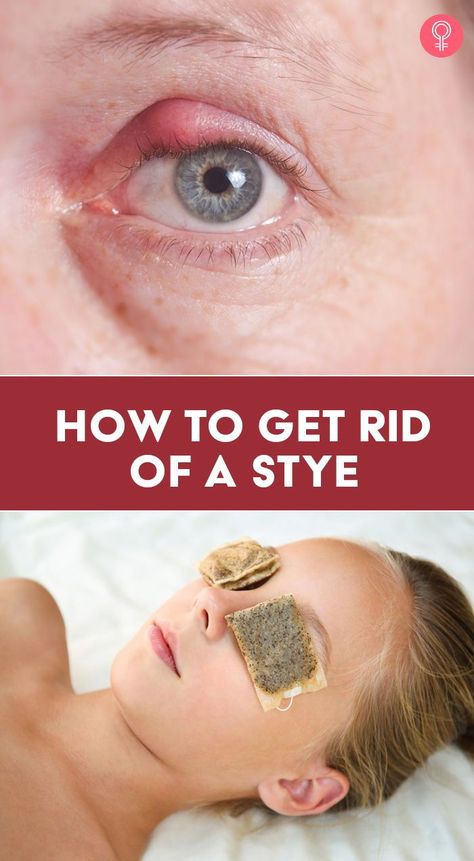 What To Do For A Sty In Your Eye, Sty In The Eye Remedies How To Get Rid, Tea Tree Oil For Eye Stye, Get Rid Of A Stye Overnight, Sty Remedy How To Get Rid, Stye Remedies Fast Essential Oils, How To Get Rid Of Stye Eye, Remedies For Stye On Eyelid, How To Get Rid Of A Stye On Your Eyelid